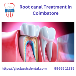 5.Root canal treatment in coimbatore