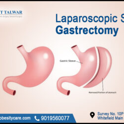 Laparoscopic sleeve gastrectomy treatment (1)