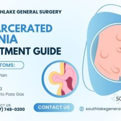 Incarcerated Hernia Treatment Guide