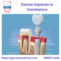 11.dental implants in saravanampatti