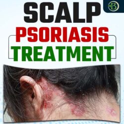 scalp psoriasis treatment (2)