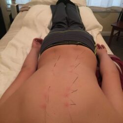 Best Acupuncture In San Jose (1)