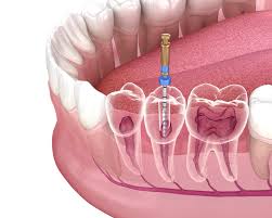 Root Canal Treatment in Calgary