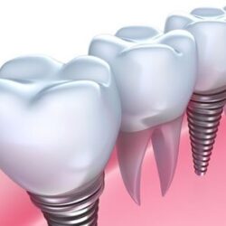 Digital Dental Implants in Sydney – Restore Your Smile with Confidence