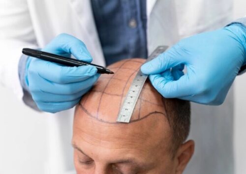 Hair Transplant in Delhi NCR Hair Transplant in Delhi NCR