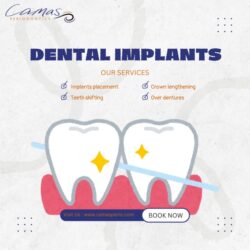 Why Choose Camas Periodontics for Dental Implants