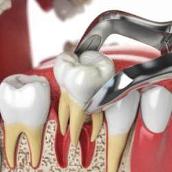 toothExtration_EnlightenDental