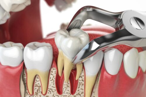 toothExtration_EnlightenDental toothExtration_EnlightenDental