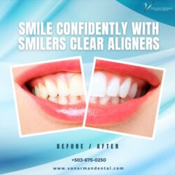Best Smilers Clear Aligners