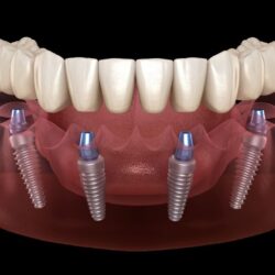 all-on-4-teeth-savers-dental-clinic-in-tijuana