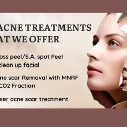 Acne treatment (1)