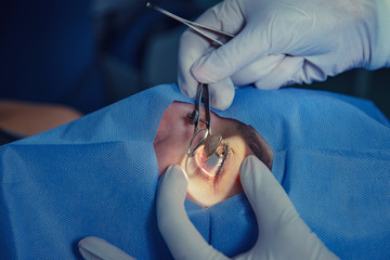 Cataract treatment Cataract treatment