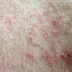 Atopic dermatitis in Houston