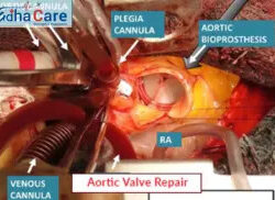 1718086821aortic-valve-repair