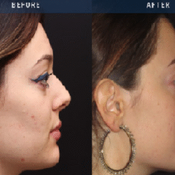 Non-surgical Rhinoplasty in Windsor