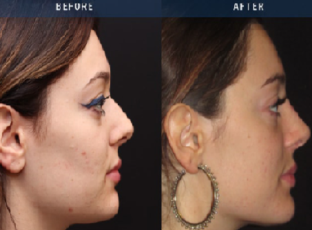 Non-surgical Rhinoplasty in Windsor Non-surgical Rhinoplasty in Windsor