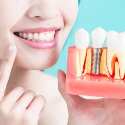 dental-implant