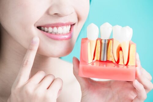 dental-implant dental-implant