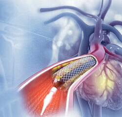 Angioplasty