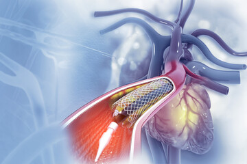 Angioplasty Angioplasty