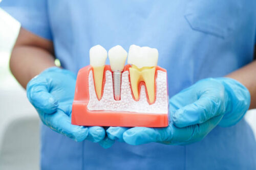 dental implant dental implant