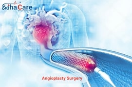 1711694400angioplasty-surgery 1711694400angioplasty-surgery