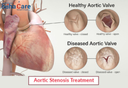 1718086470aortic-stenosis-treatment 1718086470aortic-stenosis-treatment