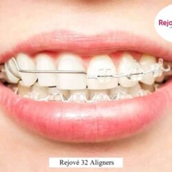 Dental Braces