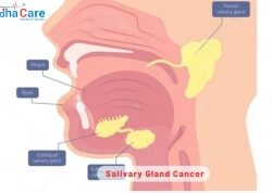 1711454027salivary-gland-cancer