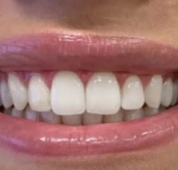 Teeth Whitening Services In London