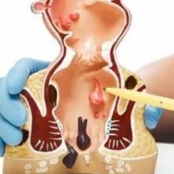 Right Clinic for Fissure Treatment in Delhi