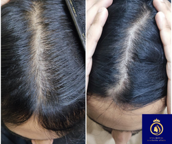 best hair regrowth for women in thane (1)