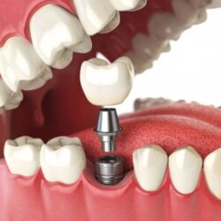 dental implants cost abbotsford