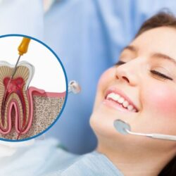 Single-Sitting-Root-Canal