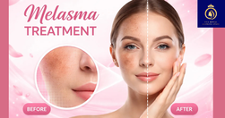 melasma image (2) (1)