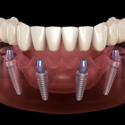 all-on-4-teeth-savers-dental-clinic-in-tijuana