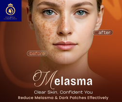 melasma image (1) melasma image (1)