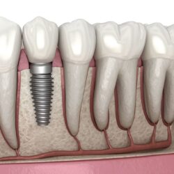 dental impants