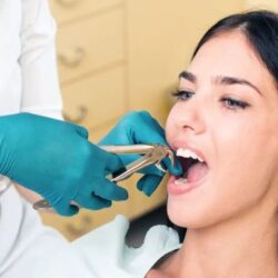 Wisdom Teeth Extraction in Artesia, CA