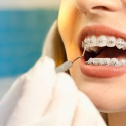 Braces-Pune-1024x660