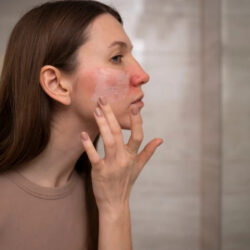 Skin-Problems-Hyderabads-Climate-Causes-1