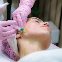 Bilaspur Acne Treatment