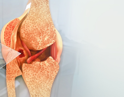 Bone cancer resize