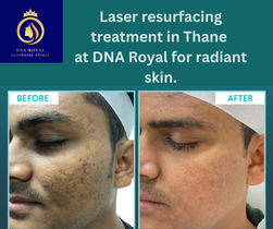 Laser Resurfacing In Thane (1)
