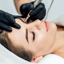 Microneedling in Burlington