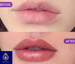 Lip Bluising (1)