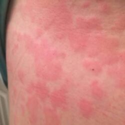 Mast Cell Activation Syndrome