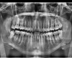 2023-04-28-PANO- PERLA LOPEZ- TEETHSAVERS