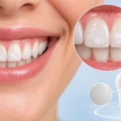 White-Spots-on-Teeth-After-Whitening-Treatments