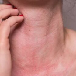 Mast Cell Activation Syndrome